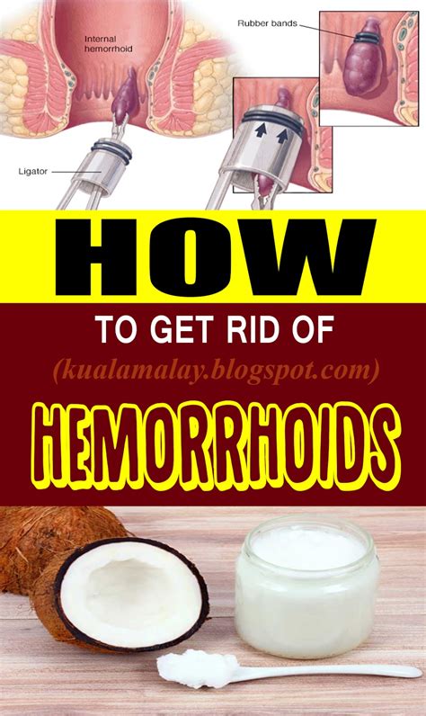 How to Get Rid of Hemorrhoids without Surgery