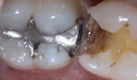 How the FDA’s New Recommendations for Dental Amalgam Affect Your ...