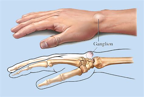 Gangalion Cysts| Symptoms & Treatment | South Florida Hand Center