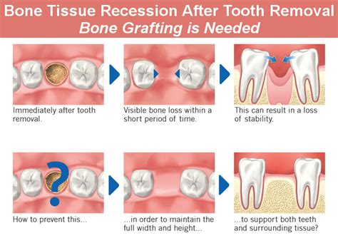 Dentist Glendale: Bone Grafting Types, How and Why Is It Done - Smile Makeover of LA