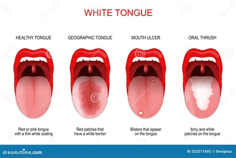 Sore Or White Tongue. Comparison Of Healthy Tongue And Oral Disease ...