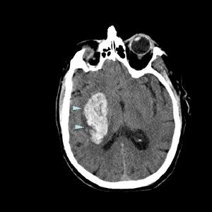 surgery: Brain hemorrhage