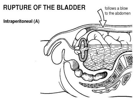 Image result for bladder serosal injury | Bladder, Injury, Abdomen