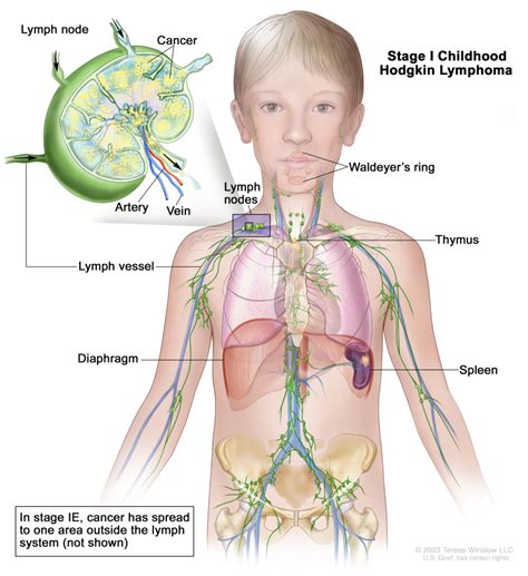 What Does Stage 2 Lymphoma Cancer Mean - CancerWalls