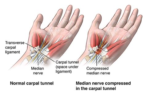 Carpal Tunnel Release - Health Encyclopedia - University of Rochester ...