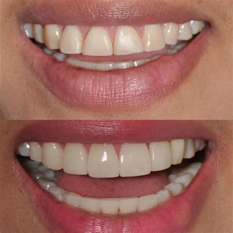 Veneers | Cosmetic Dentistry Center