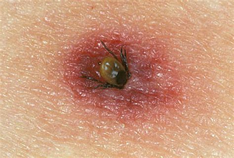 Tick bites on Humans – Images, Symptoms, Causes, Treatment - HubPages