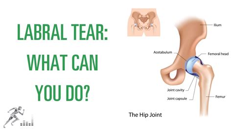 Labral tear of the hip: What is it, and how can you get better? - YouTube