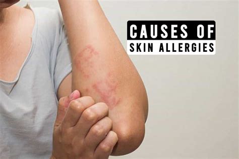 What Are The Common Causes of Skin Allergies? - Go Lifestyle Wiki