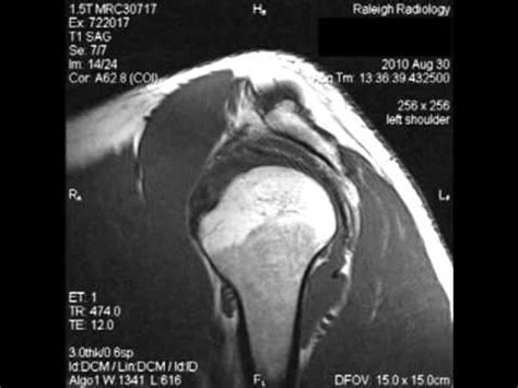 MRI on My Left Shoulder - YouTube