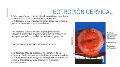 Cervicitis aguda y crónica, ectropion cervical, ulceracion, erosion.