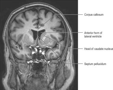 Lateral Ventricle MRI