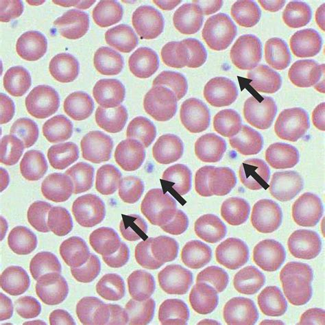Platelet Morphology | Blood Film - MedSchool