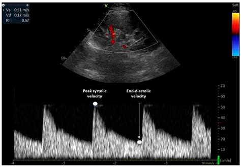 Abnormal Main Renal Artery Waveform