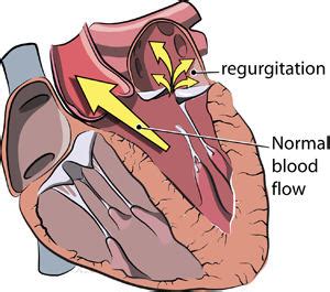 Mitral Regurgitation - Symptoms, Diagnosis, Treatment & Surgery