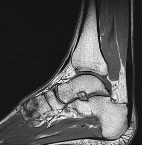 Achilles Tendon Ultrasound - Melbourne Radiology