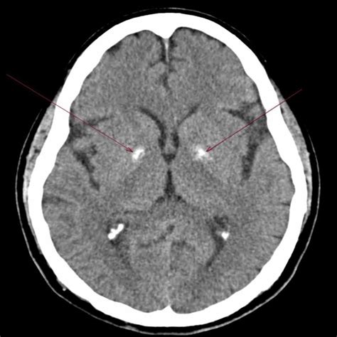 Pdf Idiopathic Basal Ganglia Calcification Associated With Cerebral ...