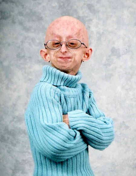 Progeria - Syndrome, Facts, Symptoms, Causes, Treatment, Home Remedies | Diseases Pictures