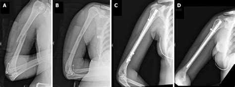 Radial nerve recovery following closed nailing of humeral shaft fractures without radial nerve ...