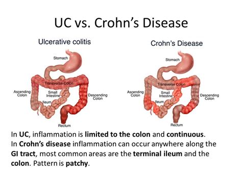 Image result for crohn's disease 420 | Crohns disease, Ulcerative colitis, Crohns