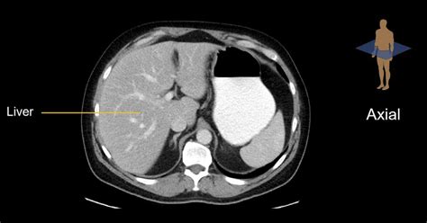 Abdominal CT: Planes • LITFL • Radiology library