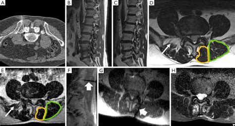 Clinical case. 68-year-old male patient with therapy-refractory low... | Download Scientific Diagram