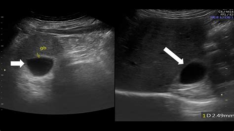 Left Lobe Liver Ultrasound