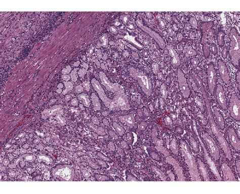 Stomach Cancer Samples - Lab-Ally