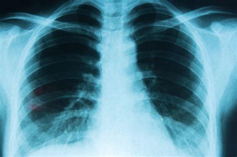 Non Small Cell Lung Cancer Causes Symptoms And Treatment - Infoupdate.org