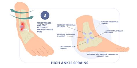 Ankle Sprain Physiotherapy - Propel Physiotherapy