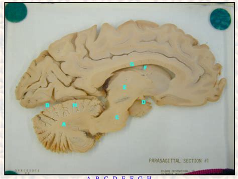 Brain: Parasagittal Section Diagram | Quizlet