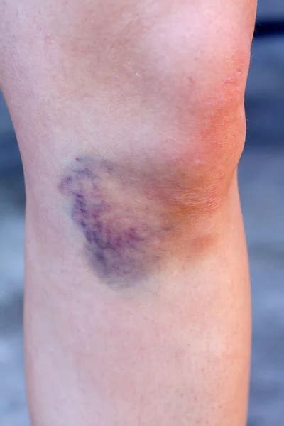 Hematomas Stock Photos, Royalty Free Hematomas Images | Depositphotos