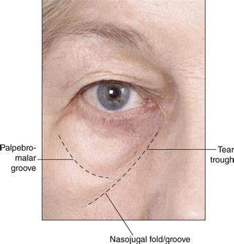 Infraorbital hollow and nasojugal fold | Plastic Surgery Key