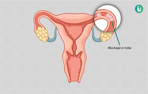 About Tubal Blockage treatment