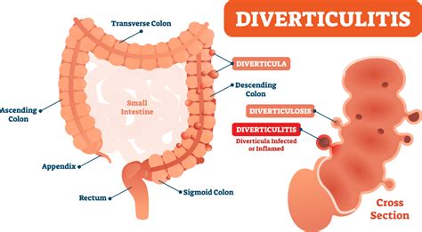 Diverting Diverticulitis - United Ostomy Associations of America