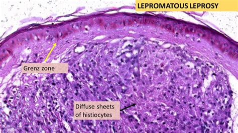 LEPROSY- Tuberculoid & Lepromatous | Pathology Made Simple