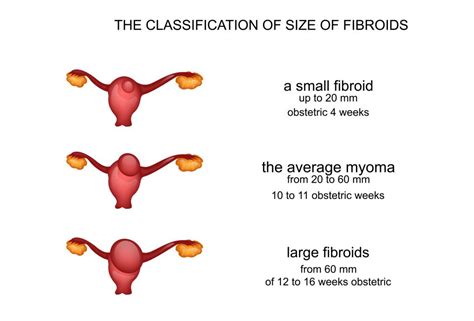 Normal Size Of Uterine Fibroids