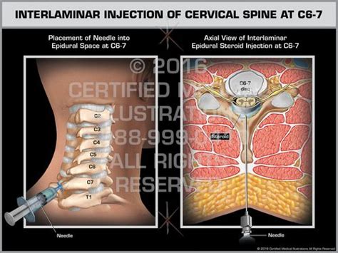 Interlaminar Injection of Cervical Spine at C6-7 - Print Quality ...