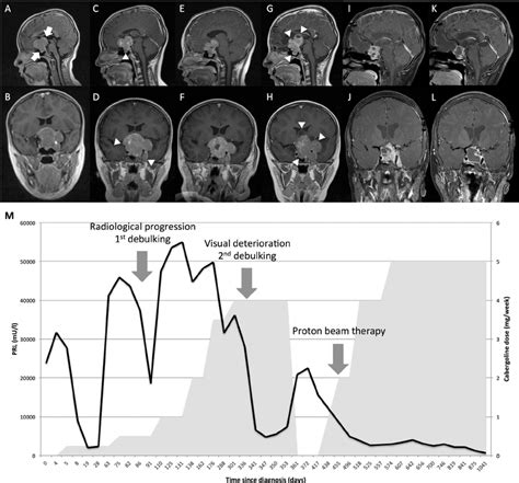 Patient MRI images and biochemistry results. Serial T 1 -weighted MRI ...