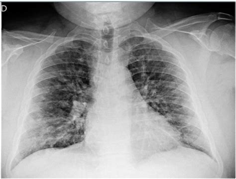 SARS-CoV2 bilateral pneumonia: Chest X-ray evolution | Medicina Intensiva