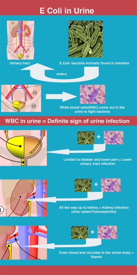 Have E Coli in urine? Here is what it means.