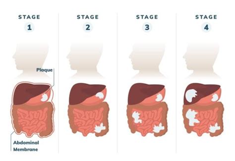 Peritoneal Mesothelioma | Treatment, Prognosis & Diagnosis