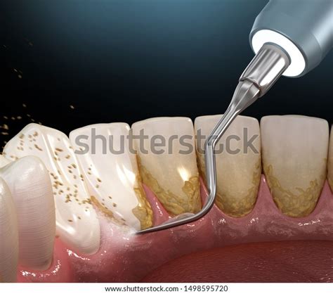 Oral Hygiene Ultrasonic Teeth Cleaning Machine Stock Illustration ...