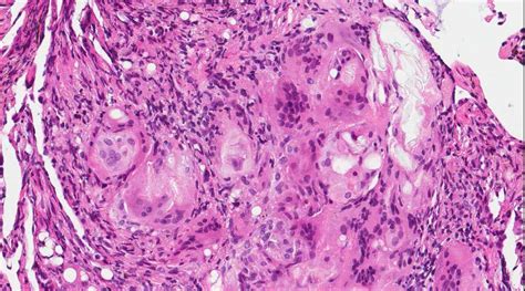 Pathology Outlines - Lipoid pneumonia