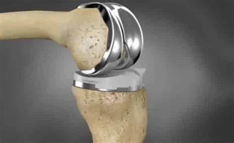 Choosing a Knee Implant / Prosthesis