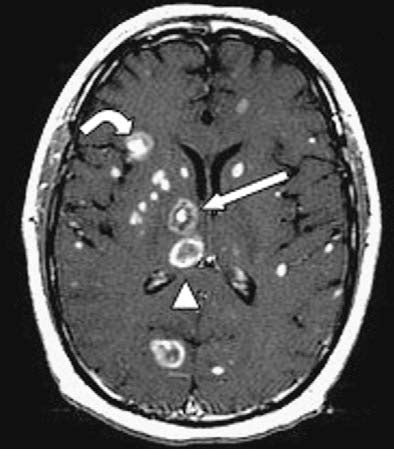 Toxoplasmosis Brain