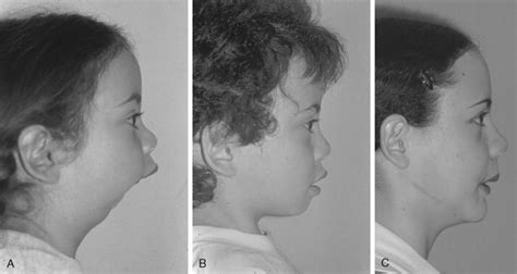 INTRAORAL DISTRACTION OSTEOGENESIS | Pocket Dentistry