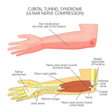 Compressed Ulnar Nerve