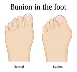 Got Big Toe Bumps and Lumps? Here’s 5 Things You Need to Know