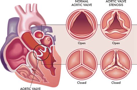 Congenital Aortic Stenosis